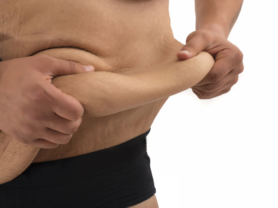 Panniculectomy Procedure, Risks, Recovery