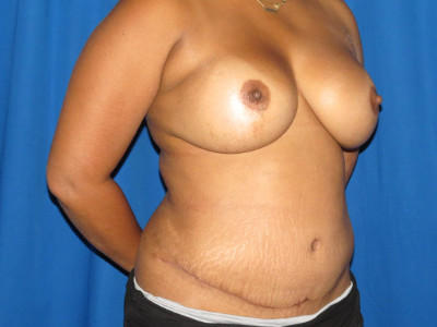 Tummy tuck after image