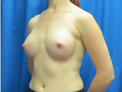 Breast enlargement front after