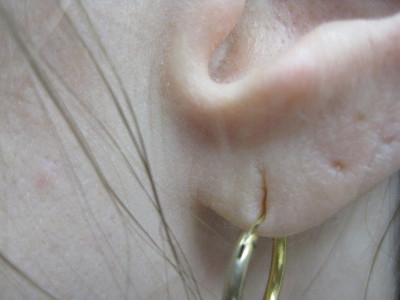 Ear repair before