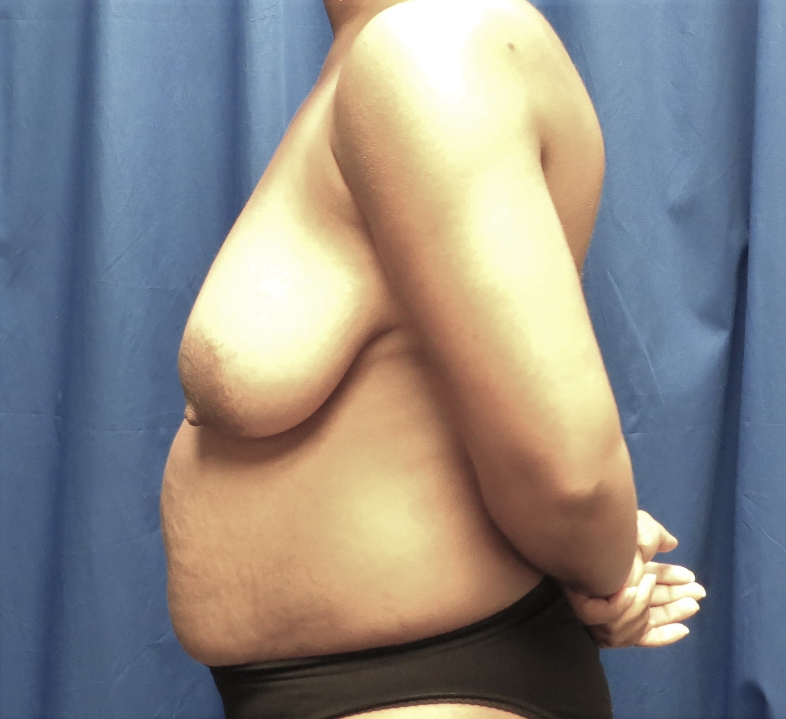 liposuction before image