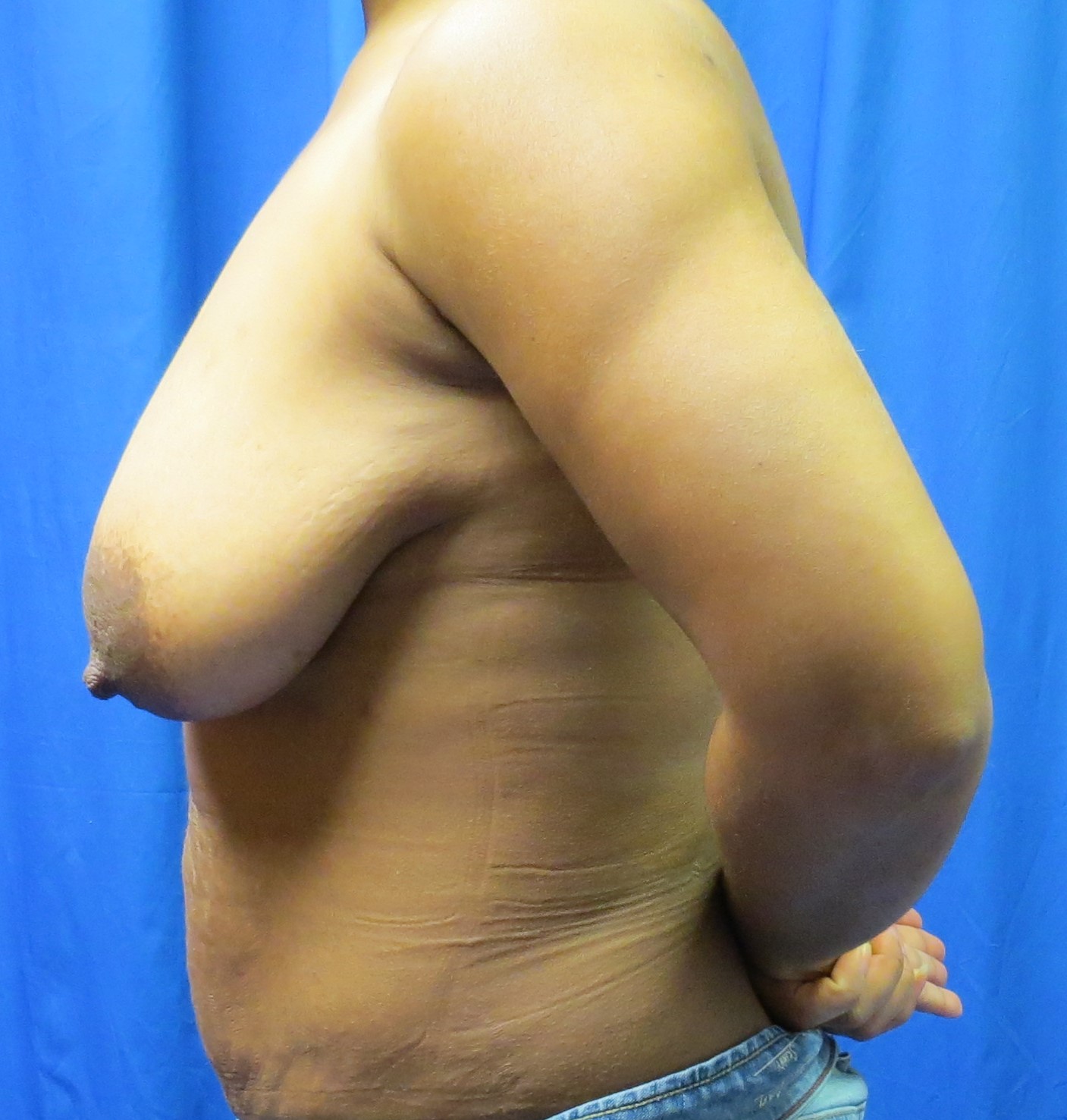 liposuction after image