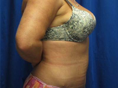 Liposuction after image