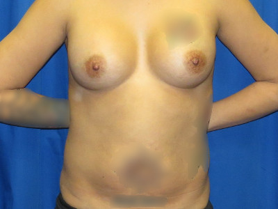Augmentation with tummy tuck before image