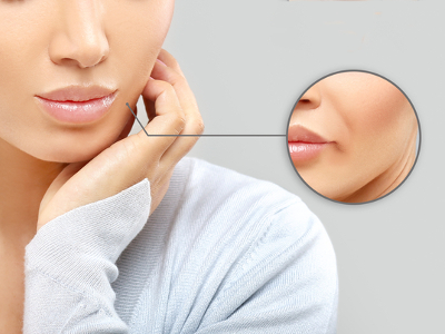 JUVEDERM FILLER